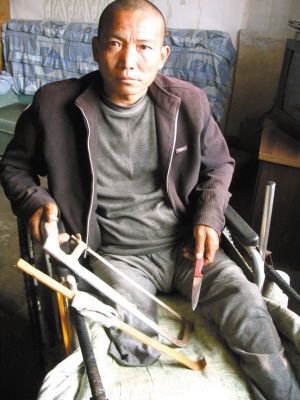 男子无钱做手术自截患病右腿 忍疼痛咬掉四颗牙