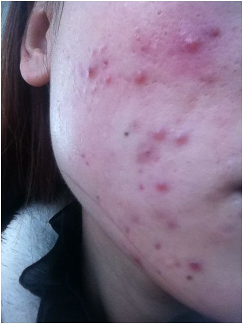 消费者花2000元买无限极 服用后满脸脓包