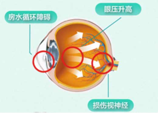 上海爱尔眼科提醒：温差波动，警惕青光眼急性不适